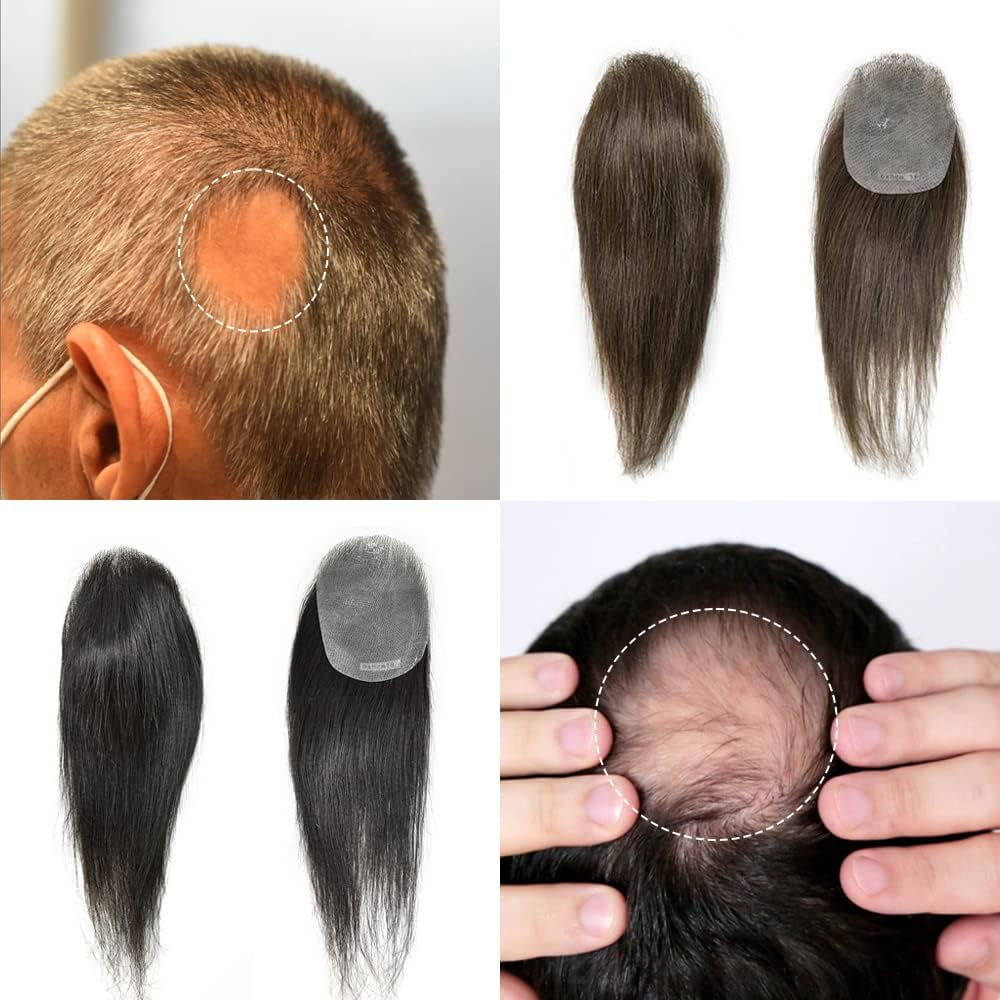 Understanding Alopecia Areata: Symptoms, Causes, Diagnosis, and Customized Hair Patch Solutions