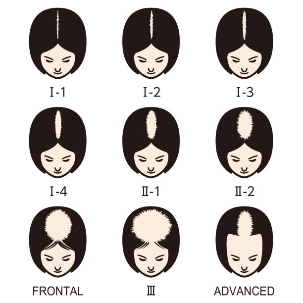 Female pattern hair loss set. Stages of baldness in women.